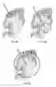 Fig. 07 - Delivery of a therapeutic agent to the cerebral cortex by administering a viral vector by convection enhanced diffusion into the white matter of the brain