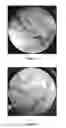 Fig. 02 - Method for crosslinking hyaluronic acid; method for preparing an injectable hydrogel; hydrogel obtained; use of the obtained hydrogel