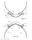 Fig. 57 - A PATIENT INTERFACE SYSTEM FOR TREATMENT OF RESPIRATORY DISORDERS