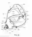 Fig. 61 - A PATIENT INTERFACE SYSTEM FOR TREATMENT OF RESPIRATORY DISORDERS