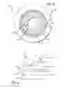 Fig. 06 - Reinforced balloon catheter