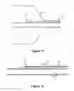 Fig. 12 - Reinforced balloon catheter