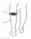 Fig. 01 - Transcutaneous electrical nerve stimulator with automatic detection of leg orientation and leg motion for enhanced sleep analysis, including enhanced transcutaneous electrical nerve stimulation (TENS) using the same