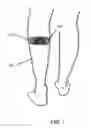Fig. 02 - Transcutaneous electrical nerve stimulator with automatic detection of leg orientation and leg motion for enhanced sleep analysis, including enhanced transcutaneous electrical nerve stimulation (TENS) using the same