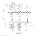 Fig. 14 - Atrial synchronized ventricular pacing system using intracardiac pacemaker and extracardiac atrial sensing