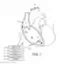 Fig. 02 - Dynamic patient-specific filtering of an activity signal within a beating heart