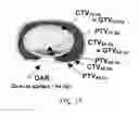 Fig. 13 - Intensity-modulated ion therapy