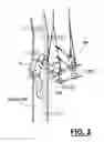 Fig. 03 - Method and apparatus of hot tapping multiple coaxial or nested strings of underwater piping and/or tubing for overturned wells or platforms