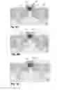 Fig. 10 - Facet-free strained silicon transistor