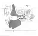 Fig. 02 - Adjustable venting for hearing instruments