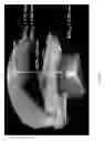 Fig. 26 - Method and system for eye measurements and cataract surgery planning using vector function derived from prior surgeries