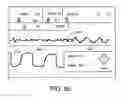 Fig. 14 - Defibrillator Display