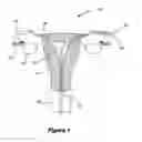 Fig. 02 - Systems and methods for maintaining a narrow body lumen