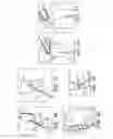 Fig. 12 - Adjustable suture-button constructs for ligament reconstruction