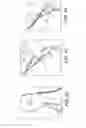Fig. 13 - Adjustable suture-button constructs for ligament reconstruction