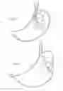 Fig. 12 - Apparatus and method for resectioning gastro-esophageal tissue