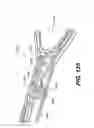 Fig. 96 - Automatic surgical ligation clip applier