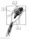 Fig. 01 - Systems and methods for removing undesirable material within a circulatory system utilizing a balloon catheter