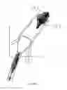 Fig. 04 - Systems and methods for removing undesirable material within a circulatory system utilizing a balloon catheter