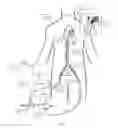 Fig. 12 - Systems and methods for removing undesirable material within a circulatory system utilizing a balloon catheter