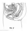 Fig. 03 - Natural orifice surgery system
