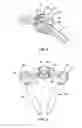Fig. 04 - Systems for spinal stabilization