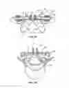 Fig. 05 - Systems for spinal stabilization