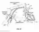 Fig. 52 - Endovascular navigation system and method
