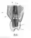 Fig. 04 - Restoration dental implant and method