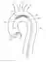 Fig. 01 - High Flow Embolic Protection Device