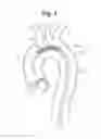 Fig. 05 - High Flow Embolic Protection Device