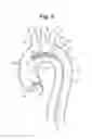 Fig. 06 - High Flow Embolic Protection Device