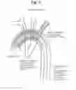Fig. 08 - High Flow Embolic Protection Device