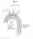 Fig. 10 - High Flow Embolic Protection Device