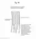 Fig. 11 - High Flow Embolic Protection Device