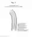 Fig. 12 - High Flow Embolic Protection Device