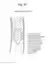 Fig. 14 - High Flow Embolic Protection Device