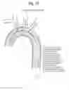 Fig. 15 - High Flow Embolic Protection Device