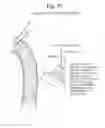 Fig. 16 - High Flow Embolic Protection Device