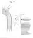 Fig. 18 - High Flow Embolic Protection Device