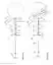 Fig. 17 - Systems, methods and devices for embolic protection