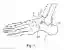 Fig. 02 - INSERTION OF AN ARTIFICIAL LIGAMENT