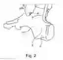 Fig. 03 - INSERTION OF AN ARTIFICIAL LIGAMENT