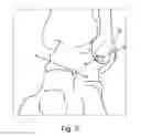 Fig. 04 - INSERTION OF AN ARTIFICIAL LIGAMENT