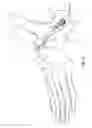 Fig. 05 - INSERTION OF AN ARTIFICIAL LIGAMENT