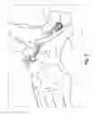 Fig. 06 - INSERTION OF AN ARTIFICIAL LIGAMENT