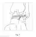 Fig. 08 - INSERTION OF AN ARTIFICIAL LIGAMENT