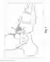 Fig. 09 - INSERTION OF AN ARTIFICIAL LIGAMENT