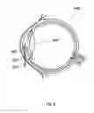 Fig. 06 - Apparatus for the treatment of cataract