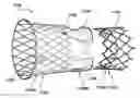 Fig. 01 - Segmented transcatheter valve prosthesis having an unsupported valve segment